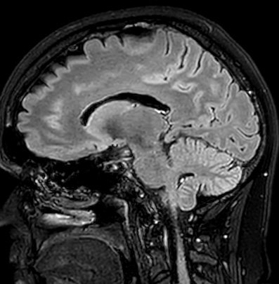 Cerebral arteriovenous malformation (Radiopaedia 74411-85746 Sagittal FLAIR 48).jpg