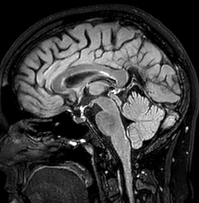 Cerebral arteriovenous malformation (Radiopaedia 74411-85746 Sagittal FLAIR 57).jpg