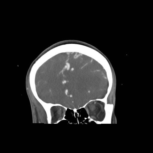 File:Cerebral arteriovenous malformation (Radiopaedia 79677-92888 B 7).jpg