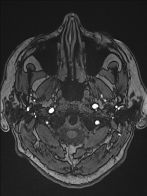 Cerebral arteriovenous malformation (Radiopaedia 84015-99245 Axial TOF 29).jpg