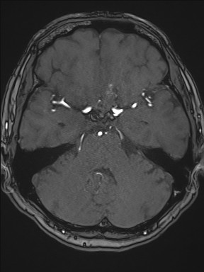 File:Cerebral arteriovenous malformation (Radiopaedia 84015-99245 Axial TOF 91).jpg