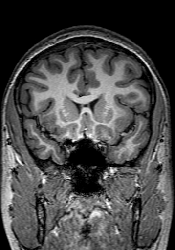 Cerebral arteriovenous malformation at posterior body of corpus callosum (Radiopaedia 74111-84925 Coronal T1 104).jpg