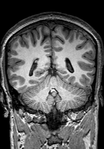 Cerebral arteriovenous malformation at posterior body of corpus callosum (Radiopaedia 74111-84925 Coronal T1 236).jpg