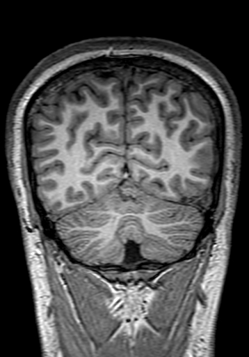 Cerebral arteriovenous malformation at posterior body of corpus callosum (Radiopaedia 74111-84925 Coronal T1 280).jpg