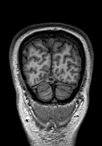 Cerebral arteriovenous malformation at posterior body of corpus callosum (Radiopaedia 74111-84925 Coronal T1 319).jpg