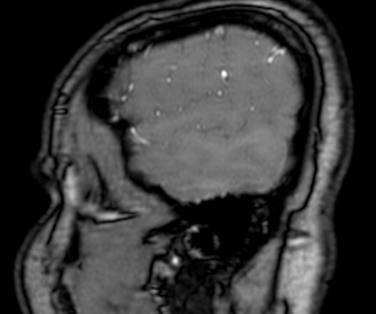 Cerebral arteriovenous malformation at posterior body of corpus callosum (Radiopaedia 74111-84925 J 16).jpg