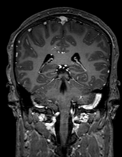 Cerebral arteriovenous malformation at posterior body of corpus callosum (Radiopaedia 74111-84925 K 238).jpg