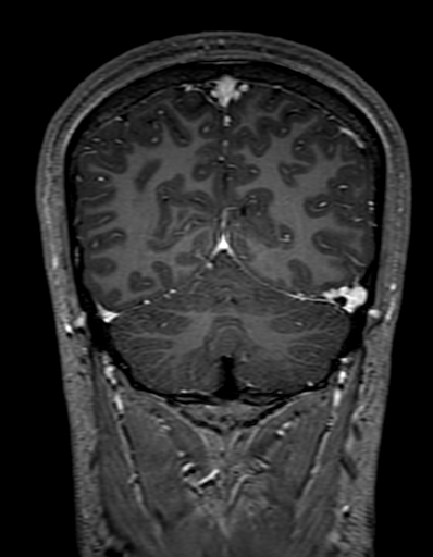 Cerebral arteriovenous malformation at posterior body of corpus callosum (Radiopaedia 74111-84925 K 292).jpg
