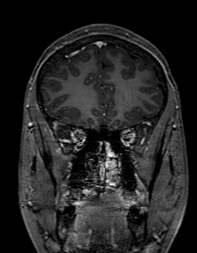 Cerebral arteriovenous malformation at posterior body of corpus callosum (Radiopaedia 74111-84925 K 85).jpg
