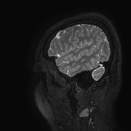 Cerebral arteriovenous malformation at posterior body of corpus callosum (Radiopaedia 74111-84925 Sagittal T2 10).jpg