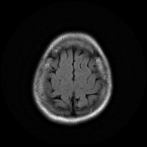 File:Cerebral autosomal dominant arteriopathy with subcortical infarcts and leukoencephalopathy (CADASIL) (Radiopaedia 41018-43768 AX FLAIR (Propeller) 18).png