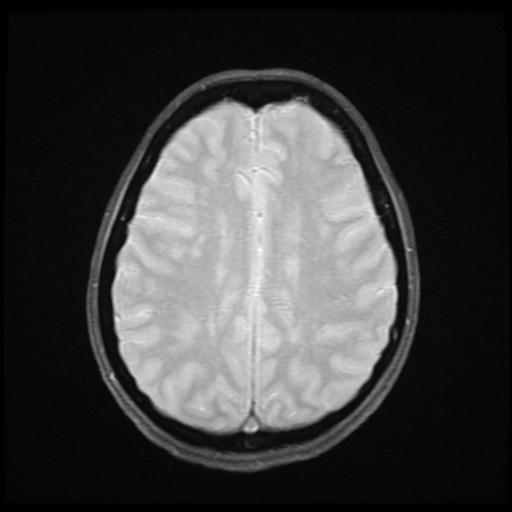 File:Cerebral autosomal dominant arteriopathy with subcortical infarcts and leukoencephalopathy (CADASIL) (Radiopaedia 41018-43768 Ax 2D MERGE 14).png