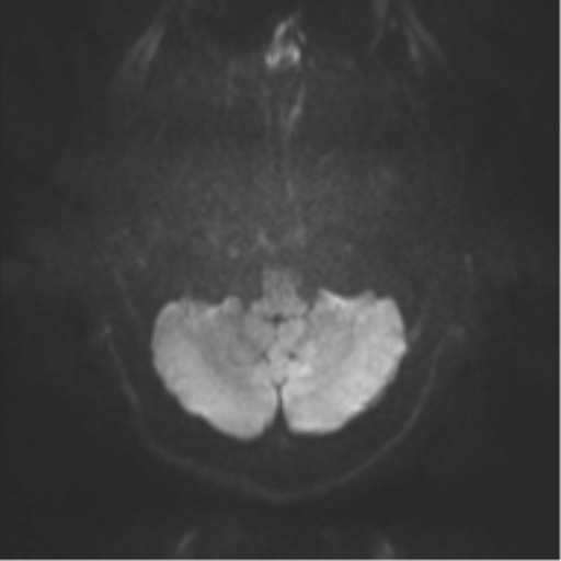 File:Cerebral cavernoma and development venous anomaly (Radiopaedia 37603-39482 Axial DWI 28).png