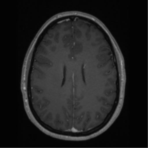 Cerebral cavernoma and development venous anomaly (Radiopaedia 37603-39482 Axial T1 C+ 49).png
