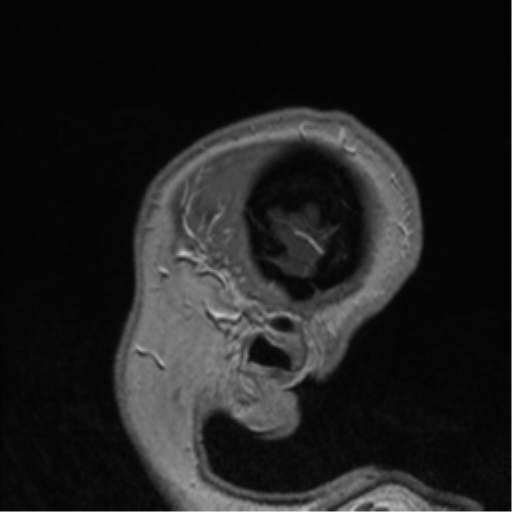 Cerebral cavernoma and development venous anomaly (Radiopaedia 37603-39482 Sagittal T1 C+ 88).png