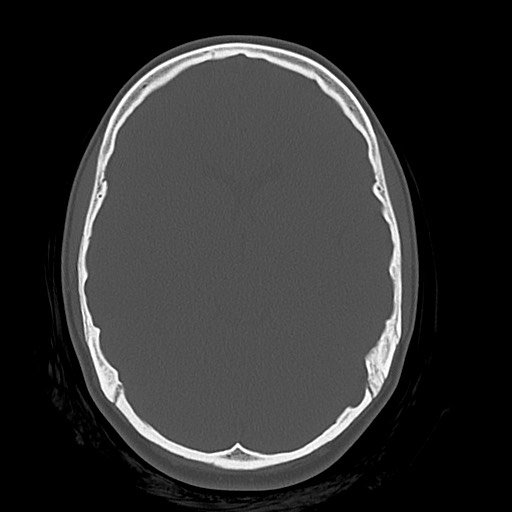 File:Cerebral cavernous venous malformation (Radiopaedia 70008-80022 Axial bone window 21).jpg