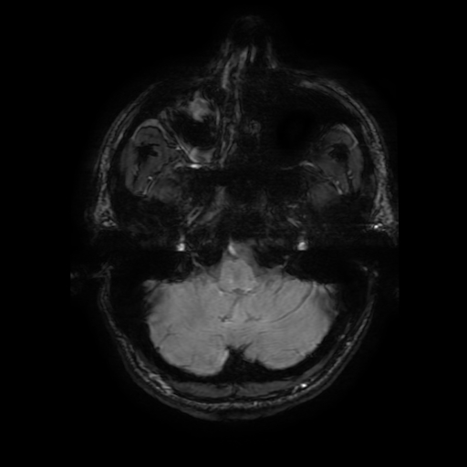 File:Cerebral cavernous venous malformation (Zabramski type II) (Radiopaedia 85511-101198 Axial SWI 23).jpg