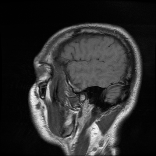 File:Cerebral cavernous venous malformation (Zabramski type II) (Radiopaedia 85511-101198 Sagittal T1 30).jpg