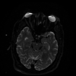 Cerebral embolic infarcts (embolic shower) (Radiopaedia 49837-55108 Axial DWI 31).jpg