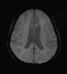 Cerebral embolic infarcts (embolic shower) (Radiopaedia 72391-82921 Axial SWI 45).jpg