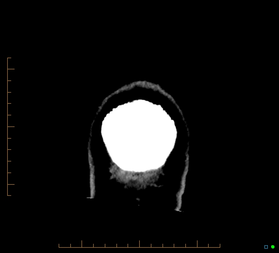 Cerebral fat embolism (Radiopaedia 85521-101224 Coronal non-contrast 63).jpg