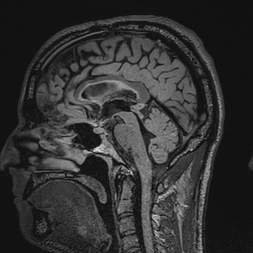 File:Cerebral hemorrhagic contusions- temporal evolution (Radiopaedia 40224-42757 Sagittal T1 41).png