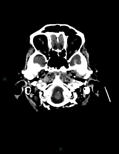 Cerebral metastases - ependymal and parenchymal (Radiopaedia 79877-93131 Axial C+ delayed 7).jpg