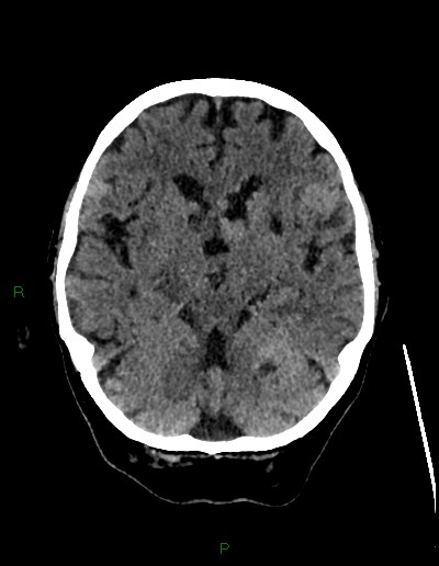 Cerebral metastases - ependymal and parenchymal (Radiopaedia 79877-93131 Axial non-contrast 27).jpg