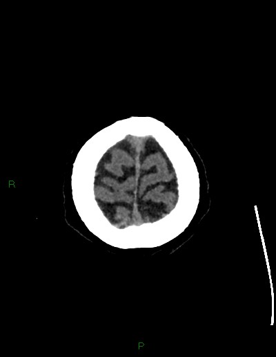 Cerebral metastases - ependymal and parenchymal (Radiopaedia 79877-93131 Axial non-contrast 76).jpg