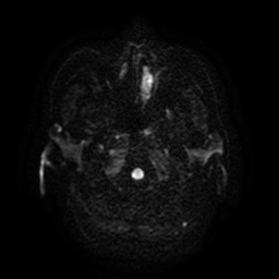 Cerebral metastases - melanoma (Radiopaedia 80972-94522 Axial DWI 35).jpg
