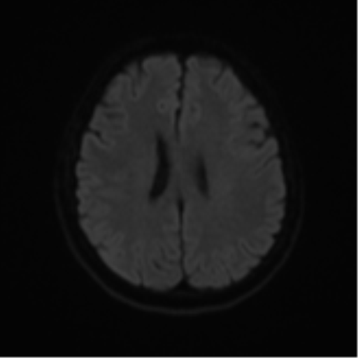 File:Cerebral metastases mimicking abscesses (Radiopaedia 45841-50131 Axial DWI 47).png