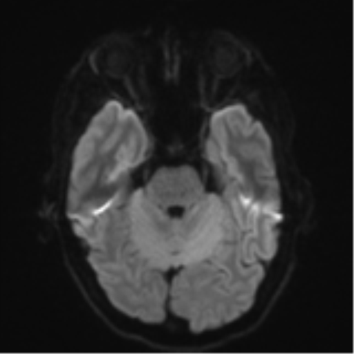 Cerebral metastasis - melanoma (Radiopaedia 54718-60954 Axial DWI 40).png