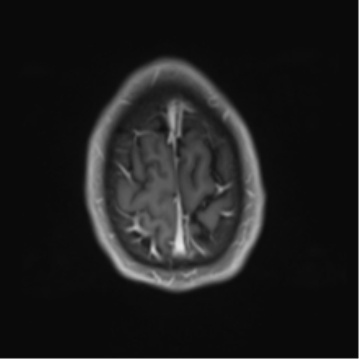 Cerebral metastasis - melanoma (Radiopaedia 54718-60954 Axial T1 C+ fat sat 47).png