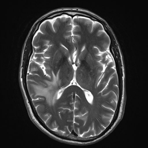 File:Cerebral metastasis - melanoma (Radiopaedia 54718-60954 Axial T2 16).png