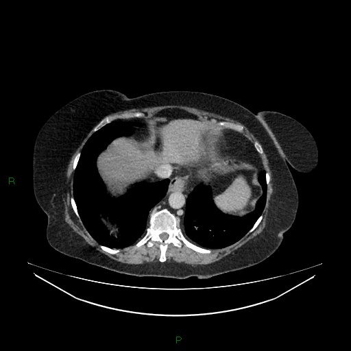 Cerebral metastasis from renal cell carcinoma (Radiopaedia 82306-96378 A 20).jpg