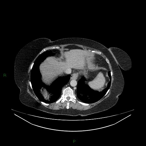Cerebral metastasis from renal cell carcinoma (Radiopaedia 82306-96378 A 21).jpg