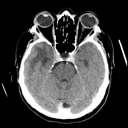 Cerebral metastasis to basal ganglia (Radiopaedia 81568-95412 Axial C+ delayed 21).png