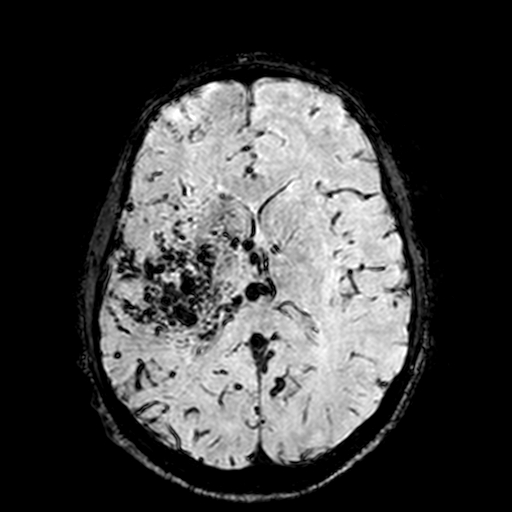 Cerebral parenchymal arteriovenous malformation (Radiopaedia 27280-27456 Axial SWI 66).jpg