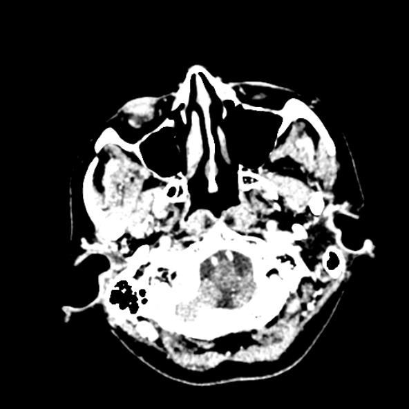 File:Cerebral ring enhancing lesions - cerebral metastases (Radiopaedia 44922-48818 B 34).jpg