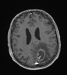 Cerebral toxoplasmosis (Radiopaedia 43956-47461 Axial T1 C+ 50).jpg