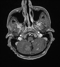 File:Cerebral toxoplasmosis (Radiopaedia 43956-47461 Axial T1 C+ 8).jpg