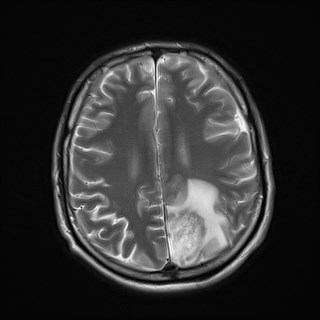 File:Cerebral toxoplasmosis (Radiopaedia 43956-47461 Axial T2 16).jpg