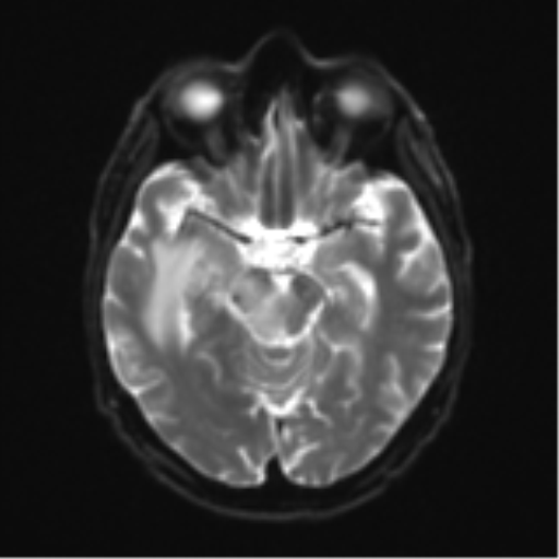 Cerebral toxoplasmosis (Radiopaedia 54575-60804 Axial DWI 14).png