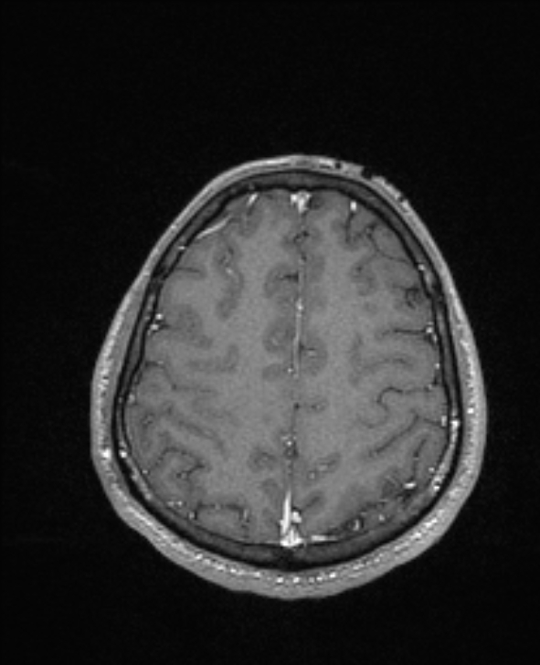 Cerebral toxoplasmosis (Radiopaedia 85779-101597 Axial T1 C+ 127).jpg