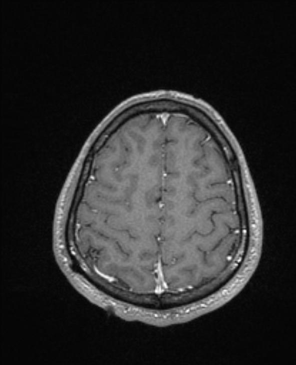 Cerebral toxoplasmosis (Radiopaedia 85779-101597 Axial T1 C+ 132).jpg