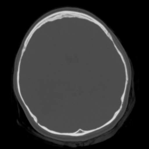 File:Cerebral tuberculosis with dural sinus invasion (Radiopaedia 60353-68018 Axial bone window 29).jpg