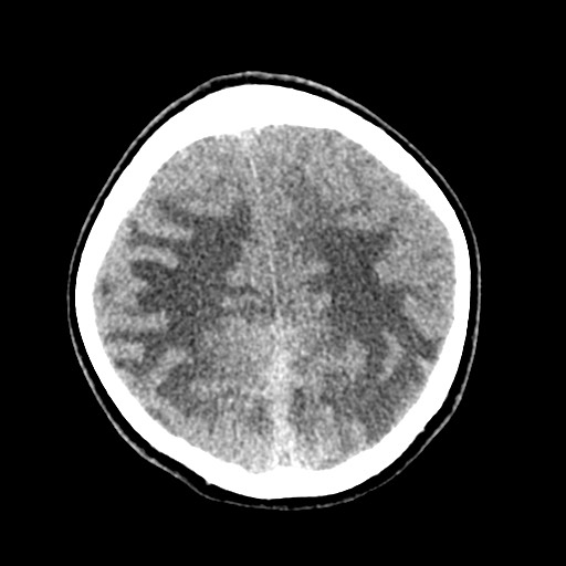 File:Cerebral tuberculosis with dural sinus invasion (Radiopaedia 60353-68018 Axial non-contrast 47).jpg