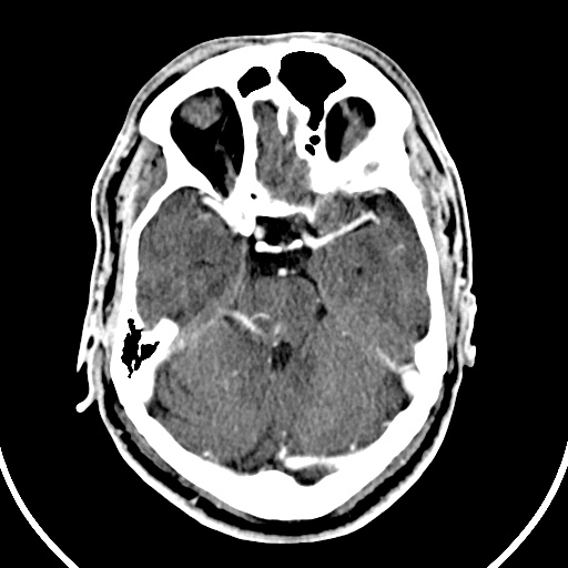 Cerebral venous angioma (Radiopaedia 69959-79977 B 21).jpg