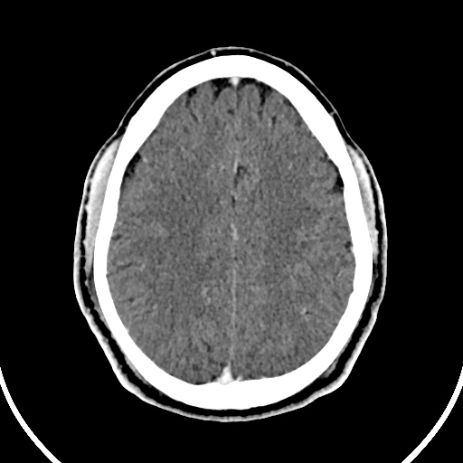 File:Cerebral venous angioma (Radiopaedia 69959-79977 B 71).jpg