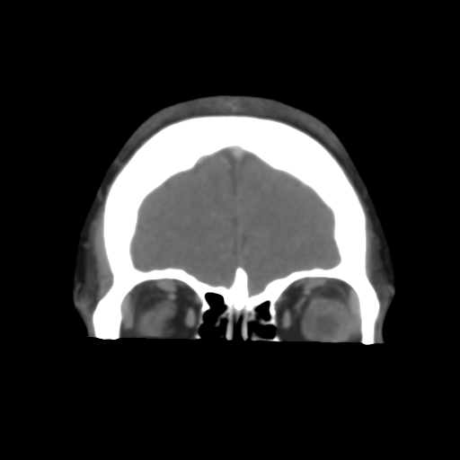 Cerebral venous infarction due to transverse sinus thrombosis (Radiopaedia 34688-36120 Coronal 14).png
